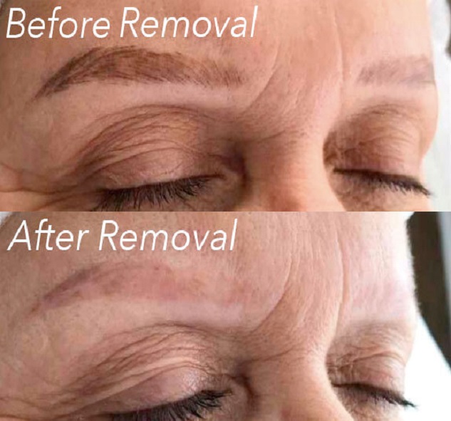 Tattoo Removal Seattle – Focus Beauty And Brows